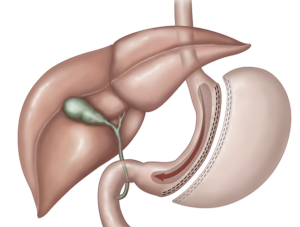 sleeve-gastrectomy-schemat